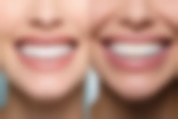 登腾全瓷牙与爱尔创全瓷牙哪个更优质？齐全对比分析二者的优缺点。