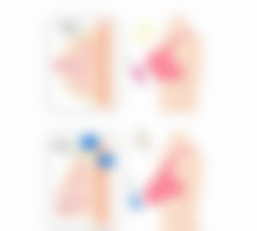 苏州常春藤林德金医生胸部整形技术怎么样？