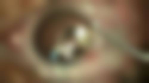 杭州爱贝芙注射注意事项