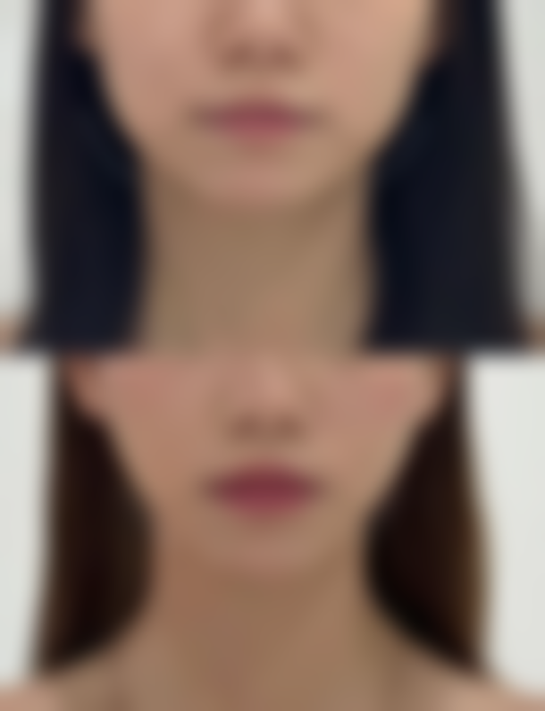 永安茜茜科美医疗美容门诊部钟玉凤医生激光祛斑技术怎么样?