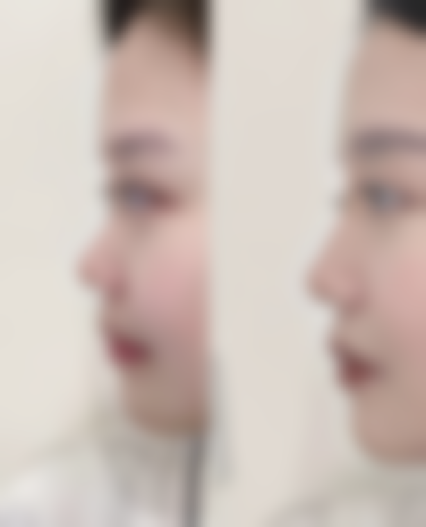 北京博美整形医院袁玲风医生自体软骨隆鼻技术怎么样？