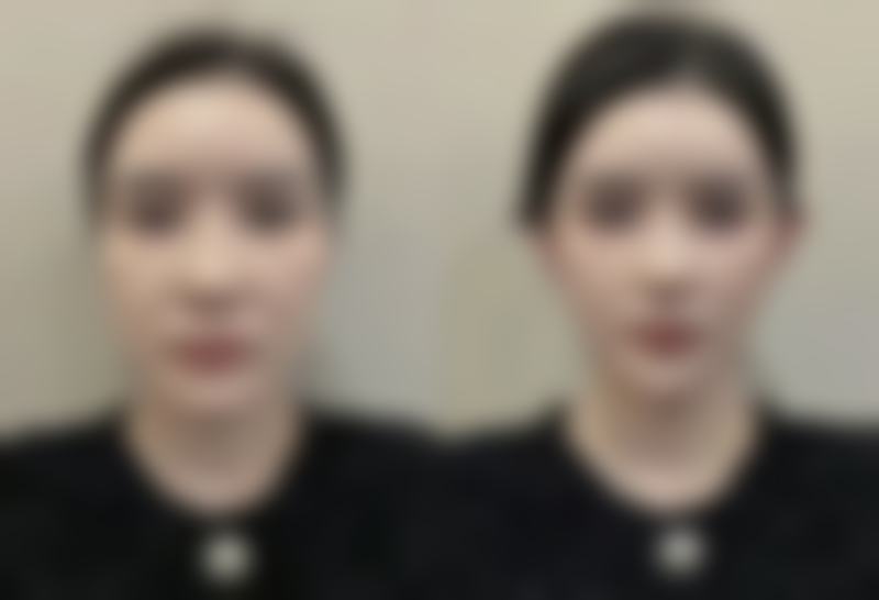 重庆易凡蕴俏医疗美容诊所王佑兴医生眼部整形技术怎么样？