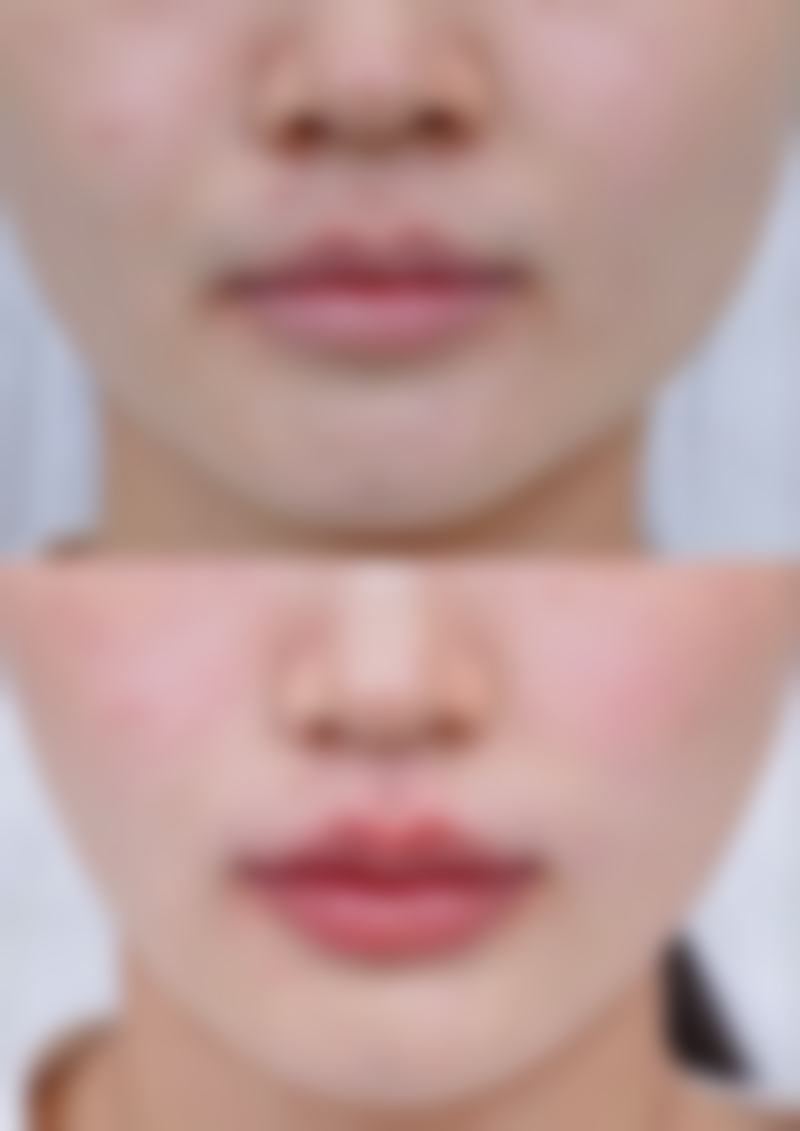 北京博美整形医院袁玲风医生鼻部整形技术怎么样?