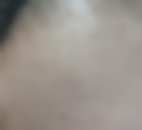 成都华美紫馨医学美容医院植发分享:术后三月成效渐显,期待早日摆脱刘海束缚!手术过程是怎样的呢?