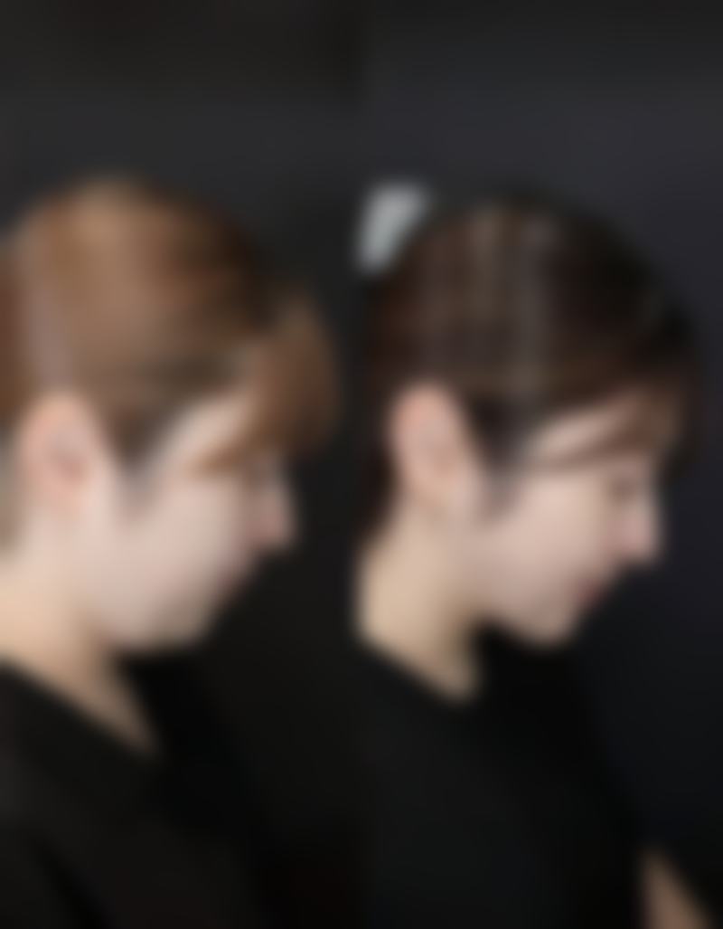 深圳大学总医院张双耀医生双眼皮技术怎么样？