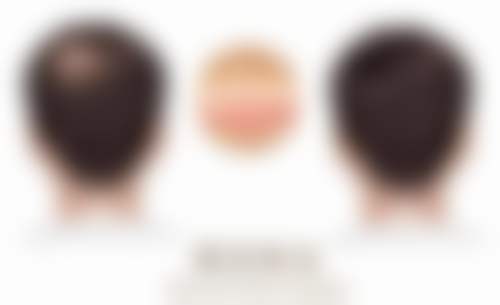 福州碧莲盛植发医院正规吗？