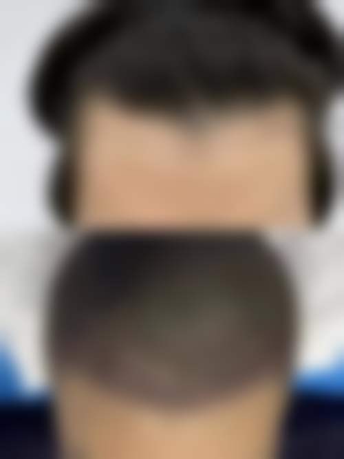 福州碧莲盛植发医院怎么预约