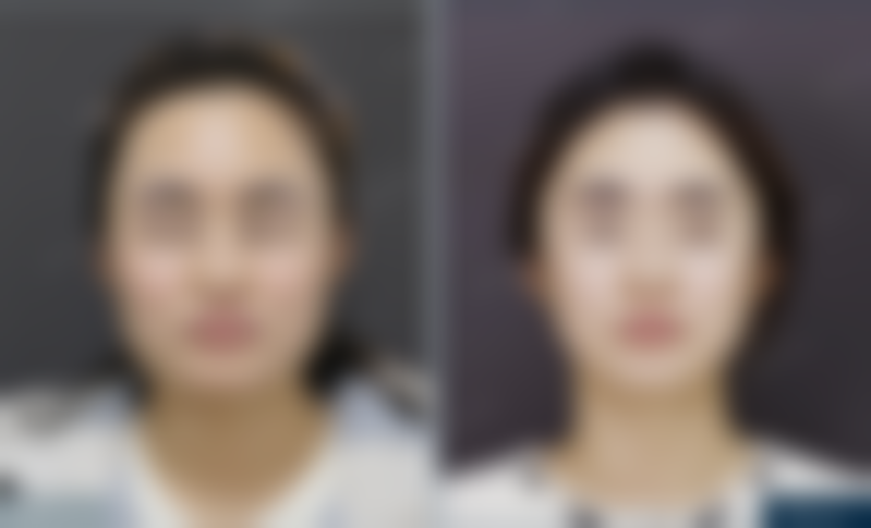 北京圣嘉新医疗美容医院帮25岁姑娘改善下颌角方盒感，成角截骨+颧骨内推效果超棒！ 