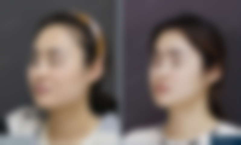 北京圣嘉新医疗美容医院帮25岁姑娘改善下颌角方盒感，成角截骨+颧骨内推手术过程是怎样的呢？