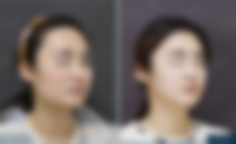 北京圣嘉新医疗美容医院帮25岁姑娘改善下颌角方盒感，成角截骨+颧骨内推术后成效到底如何呢？