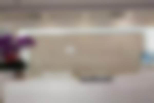 北京圣嘉新医疗美容医院26岁菱形脸姑娘改脸型案例：颧骨内推+下颌手术协调瘦脸效果棒