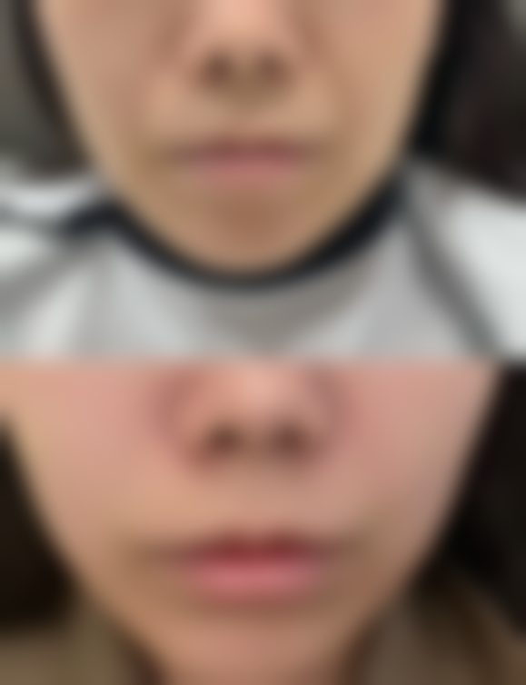 郴州青源医疗美容医院曹腾医生假体丰胸技术怎么样？