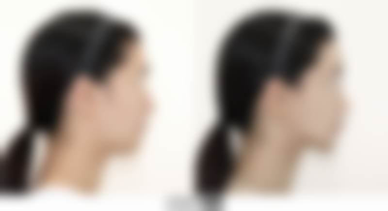 无锡大麦医疗美容诊所李绪医生植发技术怎么样？