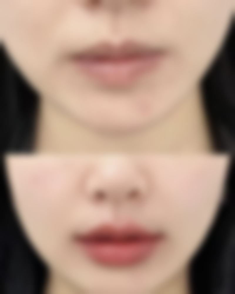 汕头大学医学校第一附属医院医学美容中 心李宇医生植发技术怎么样？