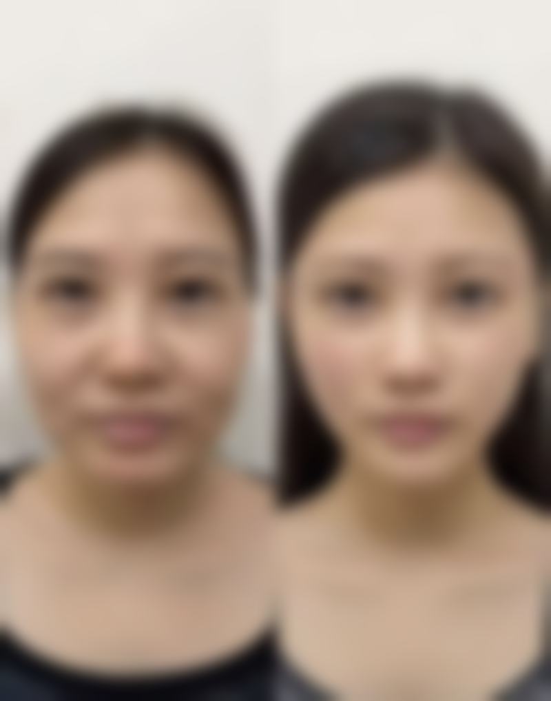 宁波明州医院整形美容中 心周惠能医生双眼皮技术怎么样?