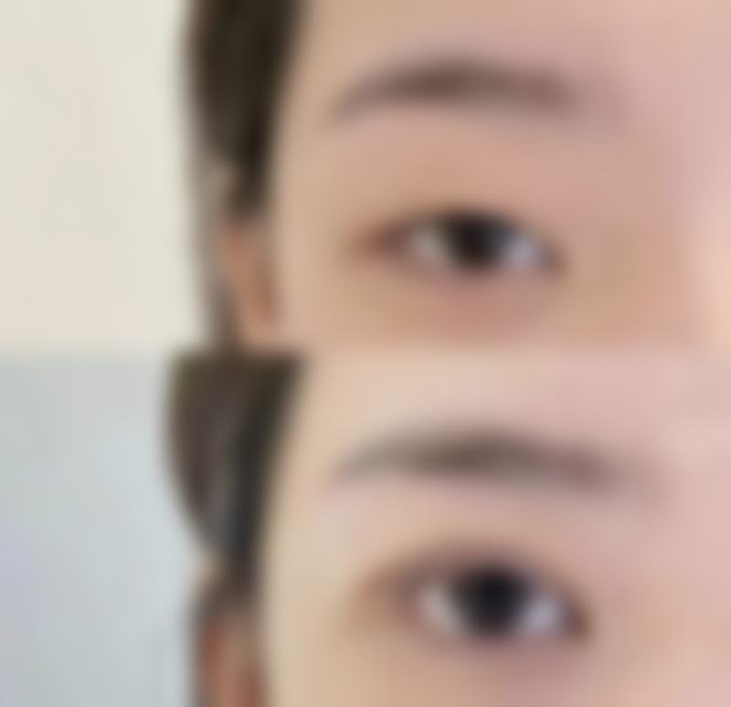 定州颜悦综合门诊部蔺洁医生眼整形手术技术怎么样？