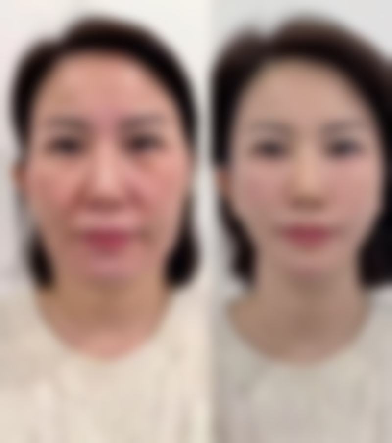 廊坊悦美医疗美容医院安阳医生鼻整形技术怎么样？