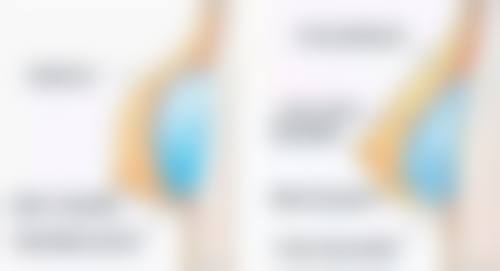 韩国well整形医院河盛允医生传统吸脂瘦大腿技术怎么样？