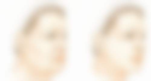 深圳大学总医院整形美容科陈梓淼医生眼部整形技术怎么样？