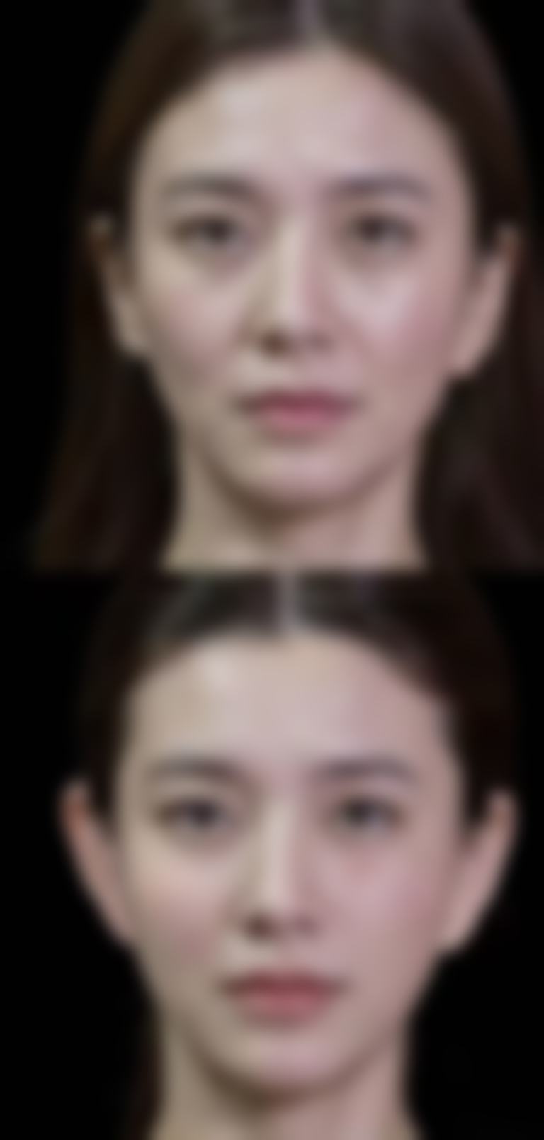 吉林大学第二医院田蕊医生双眼皮修复技术怎么样？