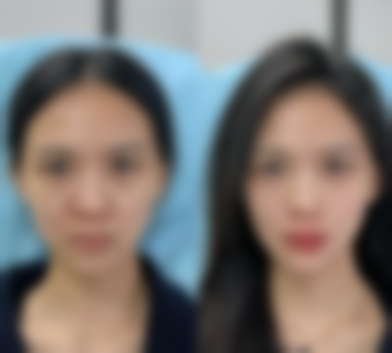 河南大学附属南石医院烧伤整形美容中 心李天宇医生吸脂减肥技术怎么样?