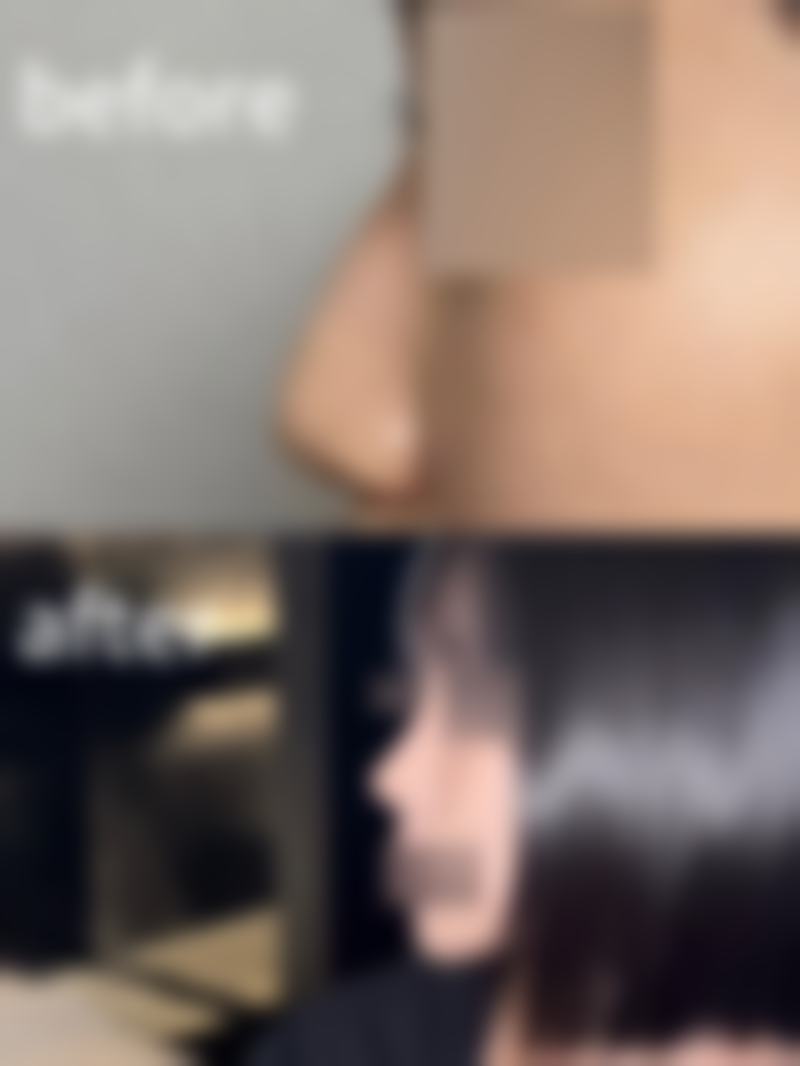 龙港颐正整形医院夏秉成医生水动力吸脂瘦大腿技术怎么样？