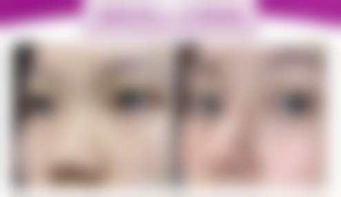 长沙雅美医疗美容医院贝丽菲尔bellafill适合哪些人群？