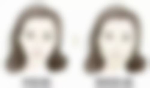 杭州雪然慕兮医疗美容诊所李少锋医生五维分层注射技术怎么样?