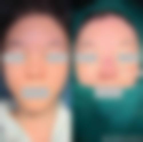 霸州鸿嘉怡美医疗美容门诊部治疗反馈与口碑评价。