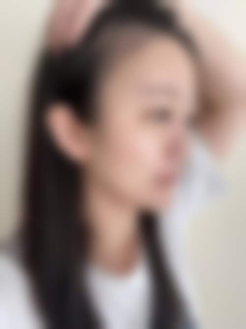 扬州俏华美医疗美容诊所调Q祛黑眼圈单次仅1000元，高军飞院长领衔专业改善色素型黑眼圈