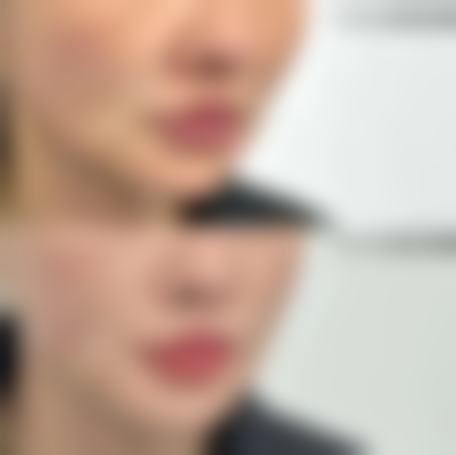 聊城市人民医院整形美容科蒋红医生注射隆鼻技术怎么样?