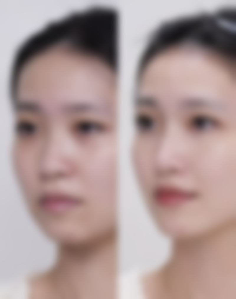 重庆迪邦皮肤病医院陈积洪医生鼻部整形技术怎么样?