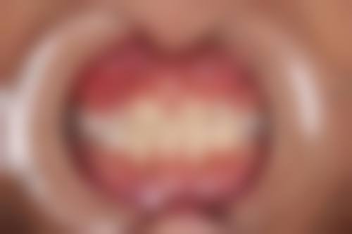 临床实例分享——呼和浩特汇博尔口腔门诊部李苛苛医生实例