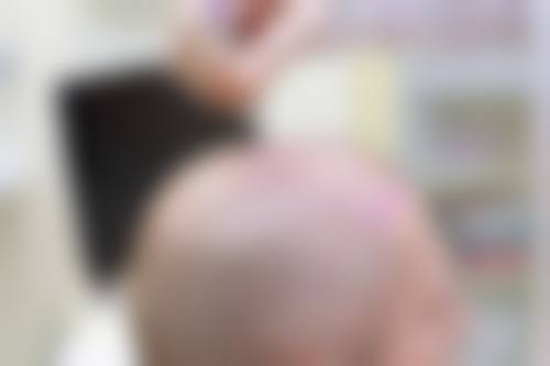 李绪医生擅长哪些植发项目?从发际线到胡须全覆盖